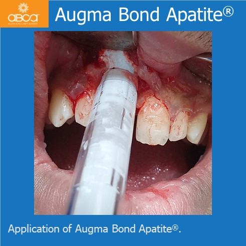 Implant and Augma in the Aesthetic Zone